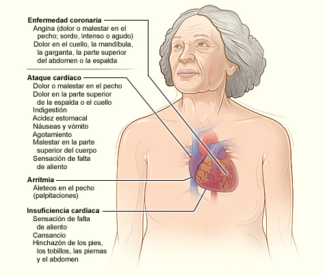 Otros síntomas de enfermedades cardiacas