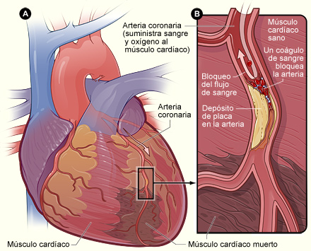 ataque cardiaco